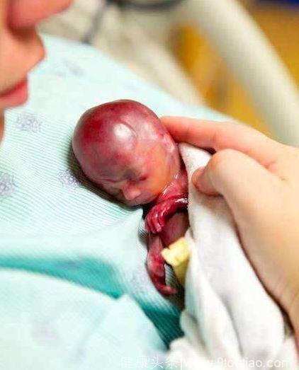 怀孕十九周的妈妈不幸早产，看到手掌大小的婴儿觉得心要碎了！