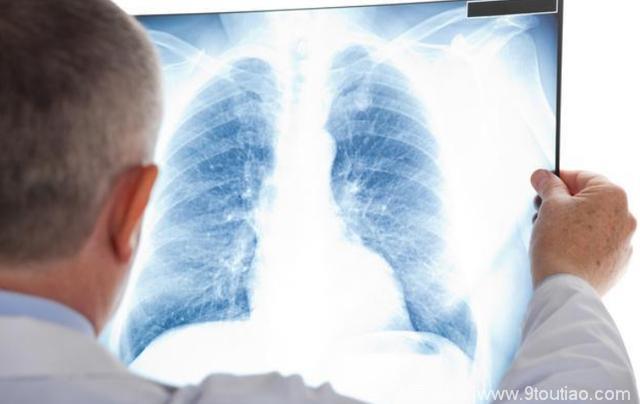 【健康】早期肺癌6种信号  出现了 千万别置之不理！吃什么好？