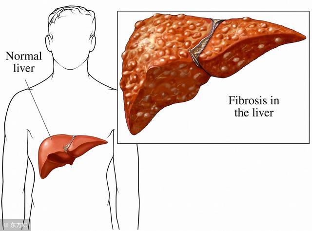 出现这4个症状小心是肝硬化 肝硬化如何预防？