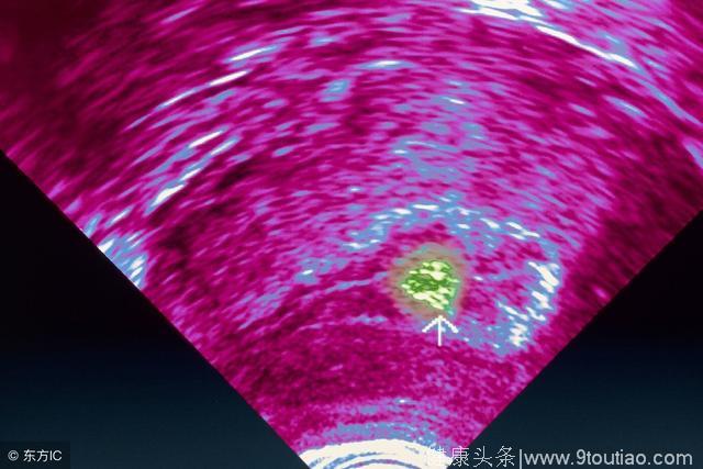 宫颈癌的致癌因素与宫颈白斑的发生有哪些直接关系