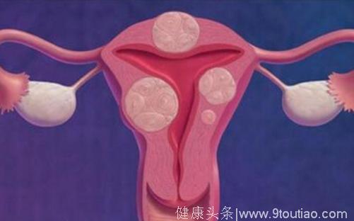 女性子宫肌瘤是怎样形成的？子宫肌瘤的症状表现都有哪些？