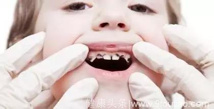 TA未来的痛都因为你现在的疼，儿童蛀牙危害到底有多大？