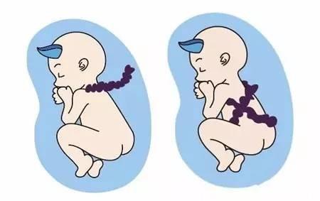 孕妈的这几种行为可能会导致宝宝脐带绕颈，看一下你中招了吗？