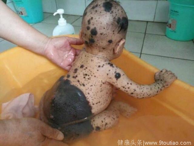 出国医疗实例：可爱的斑点宝宝，到底得的是什么病呢？