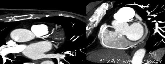 冠心病诊断，该选择无创的冠状动脉CT成像还是有创的冠状动脉造影？（103期）