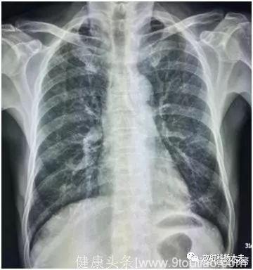 肺部CT做的节节，和胸片拍的密度增高影是一回事吗？