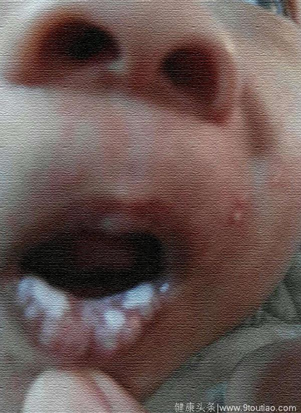 1岁宝宝口腔内全是满满的白疙瘩，竟是宝宝突然厌食导致的！