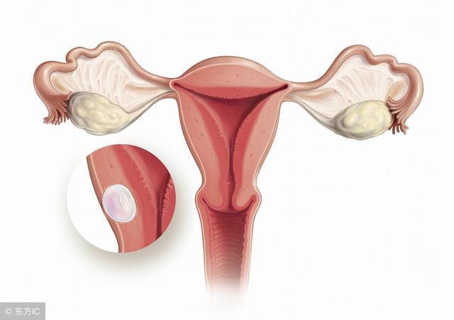 子宫肌瘤导致不孕可有的几种情况