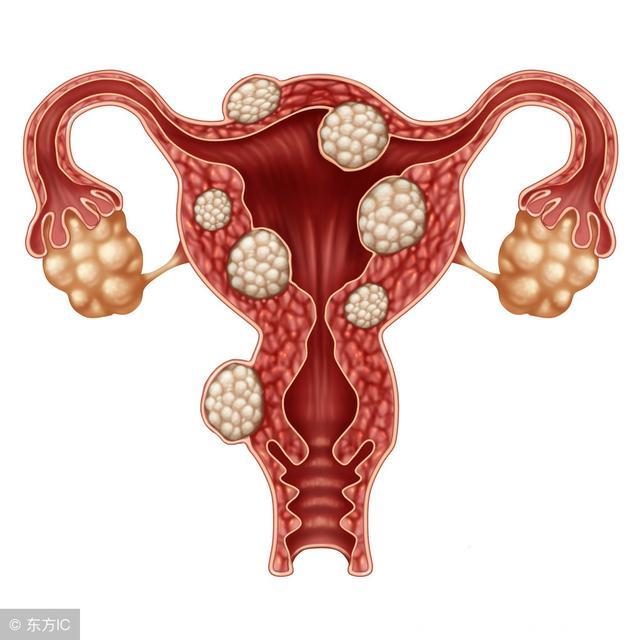 子宫肌瘤导致不孕可有的几种情况