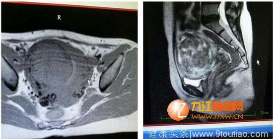 都昌县人民医院成功开展腹腔镜下子宫肌瘤剥除术