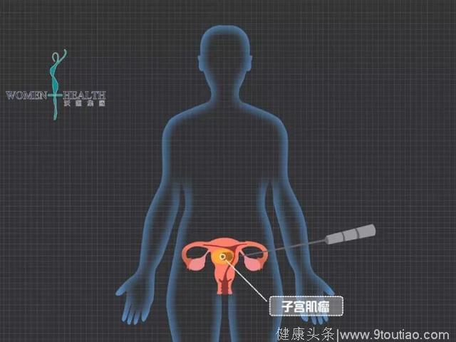 微波治疗子宫肌瘤子宫腺肌症流程