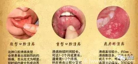 牙医必备：三类常见口腔疾病的联合用药