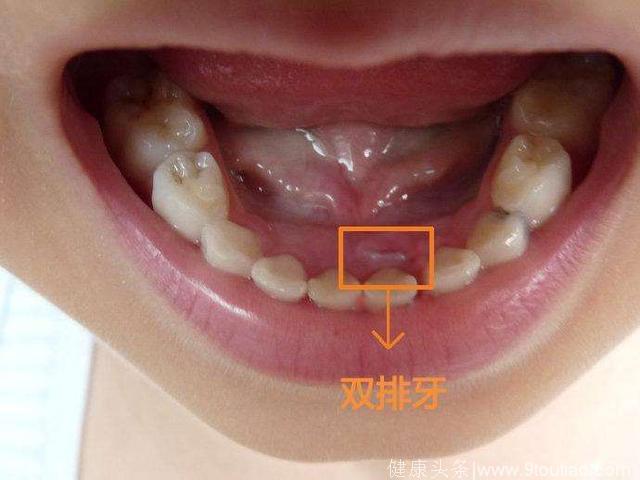 双排牙……孩子换牙期的那些麻烦该如何避过？