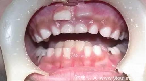 双排牙……孩子换牙期的那些麻烦该如何避过？