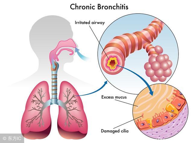 哮喘发作危害大 护理哮喘有这4个方法