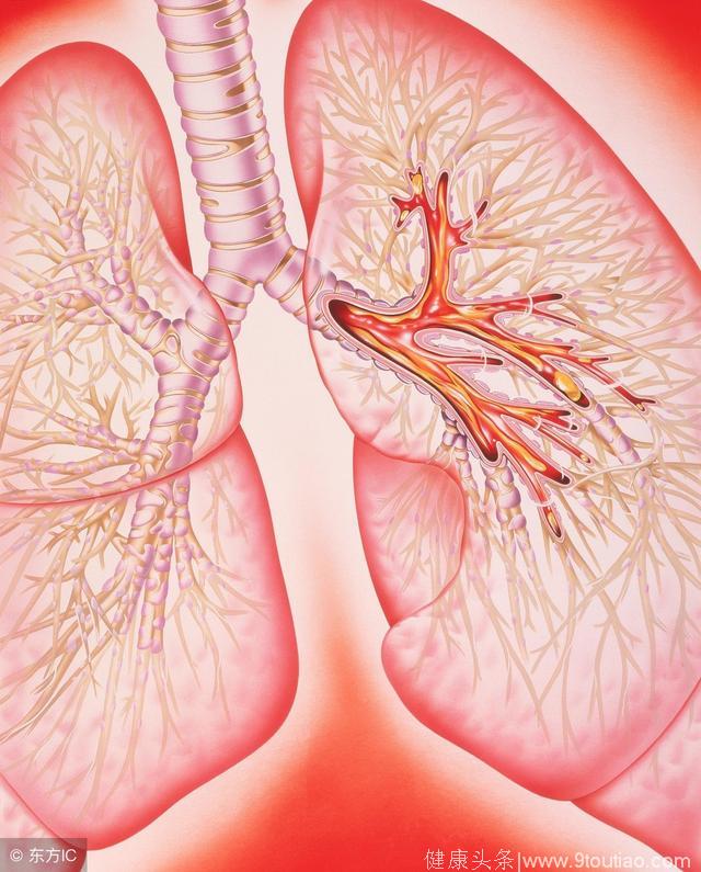 哮喘发作危害大 护理哮喘有这4个方法