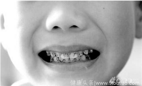 蛀牙赶紧医,否则影响孩子发音 儿童龋齿有何危害？