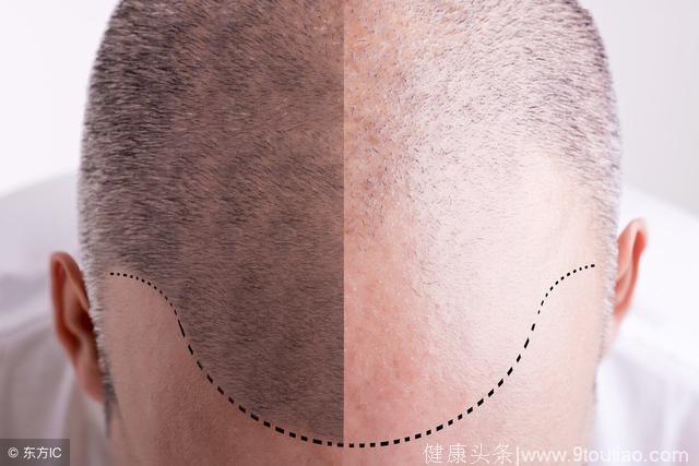中医：脂溢性重度脱发？当心秃顶！出油速度快是主要原因。