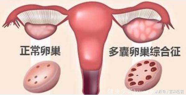 多囊卵巢综合征是怎么发生的？还有机会怀孕吗？