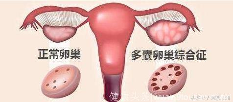 患有多囊卵巢是否能怀孕？