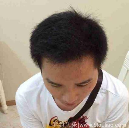 北京植发（额角+发际线）2600单位毛囊，植发后9个月效果图