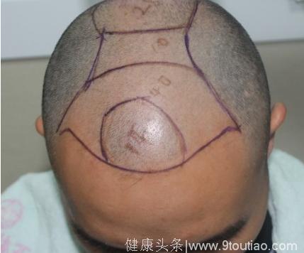 北京植发（额角+发际线）2600单位毛囊，植发后9个月效果图