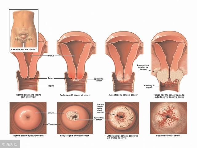子宫颈癌是怎样发生的，除了HPV感染之外还有哪些因素