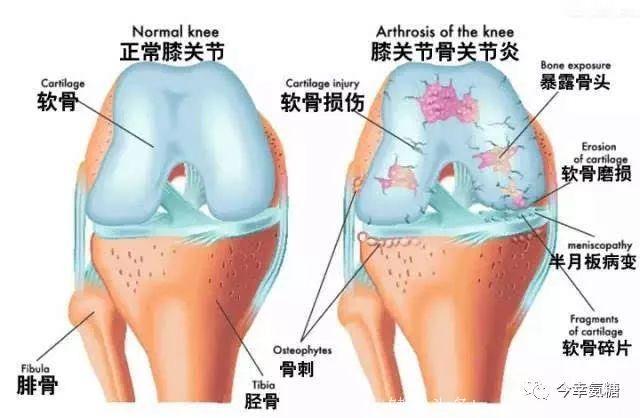 老年人常见膝关节疼痛，一个动作保护你的膝盖