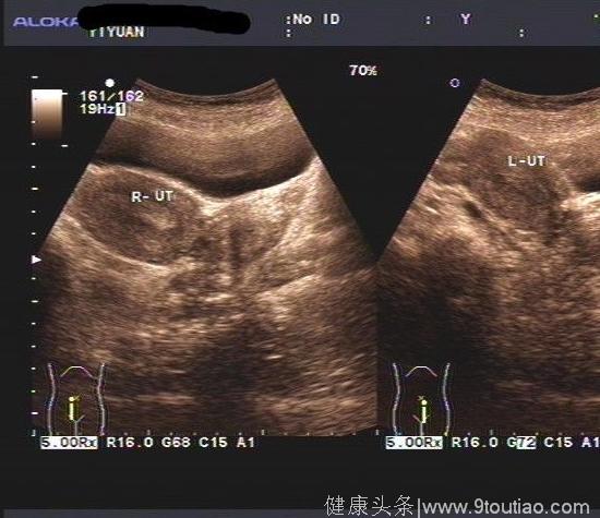 [子宫畸形] 双子宫备孕两月成功怀上了,姐妹们一定不要放弃！