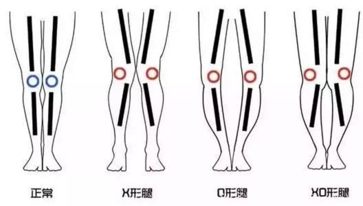如何保养膝关节？