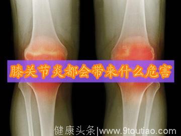 膝关节炎都会给患者带来什么危害