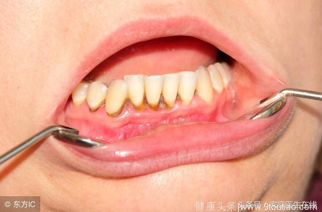 口腔里有牙结石，对人体有哪些危害？主要有3个