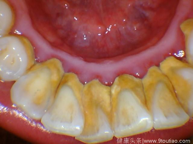 98%的人有牙结石,彻底清除刷牙未必管用,还得靠这个!