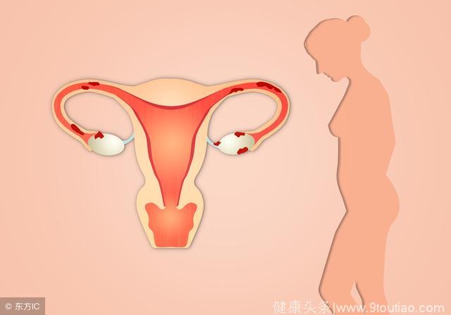 怎么做避免子宫内膜炎的危害不孕症的出现
