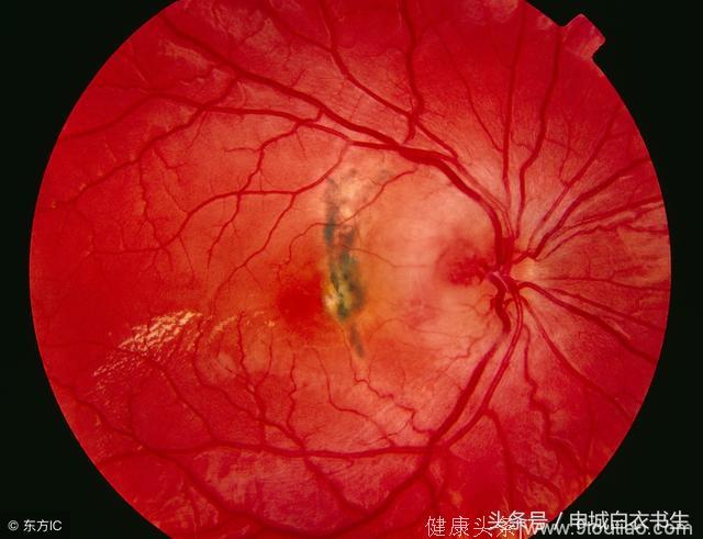 雷珠单抗，可以有效改善糖尿病视网膜病变患者的视力？