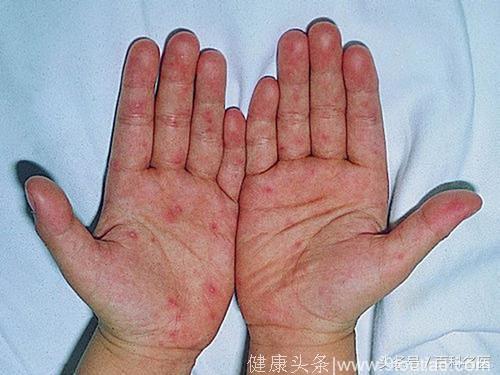 5月儿童传染病爆发！需防水痘、手足口病、腮腺炎、猩红热！