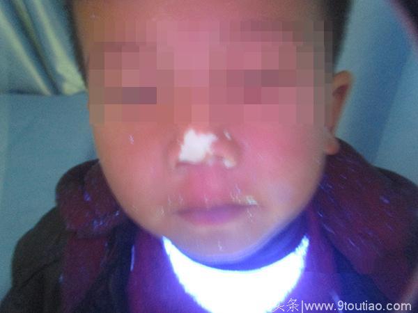 5岁男孩脸上长“虫斑”久治不退，不料竟是白癜风！