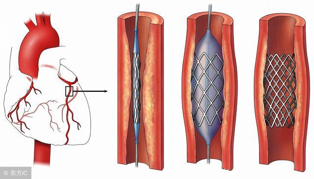 冠状动脉硬化就是冠心病吗？血管堵多少才放支架？