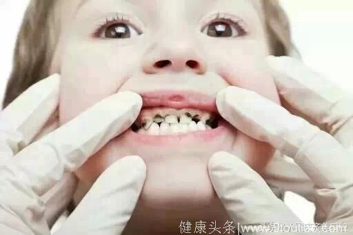 儿童有必要洗牙吗？儿童洗牙会对牙齿发育造成影响？