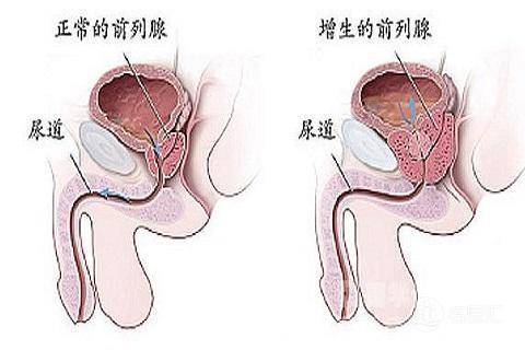 前列腺的手术治疗