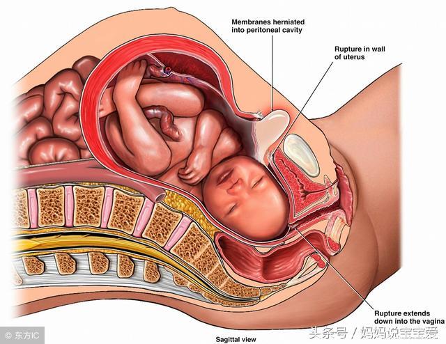 一胎剖腹产，疤痕子宫再孕，二胎还可以顺产吗？