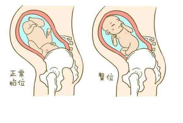 孕妇不注重胎位检查，小心胎儿胎位不正！