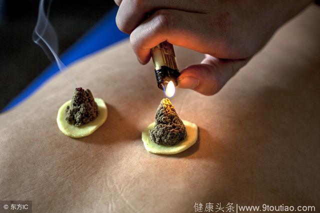 艾灸是中医的传统技艺，目前大体上分为这3种疗法