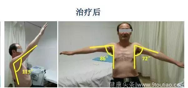 冲击波联合悬吊技术在肩周炎康复中的新应用