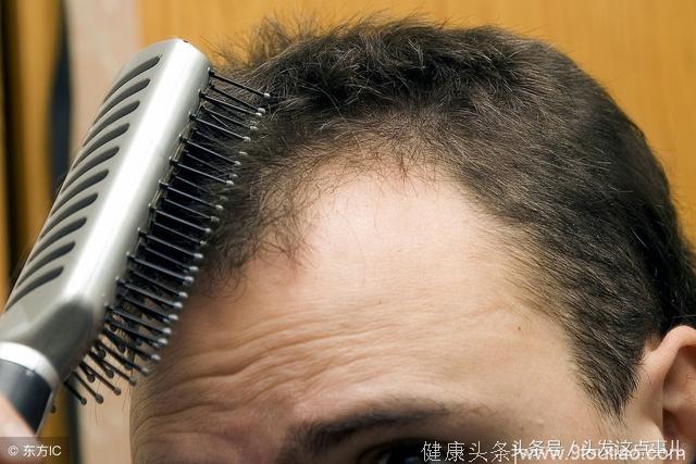 脱发还是掉发，54321法则，让你轻松自测脱发！