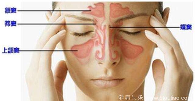 鼻窦炎会引头痛？很多人有这病却以为感冒，什么症状要注意？
