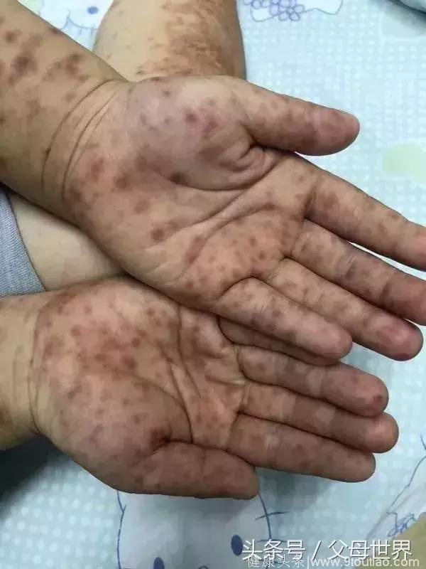 新型手足口病致5岁孩子全身皮疹！8个新病毒护理重点简单又实用
