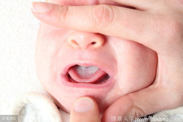 宝宝生口疮怎么办？如何预防口腔溃疡？中西医儿科专家为你解答！