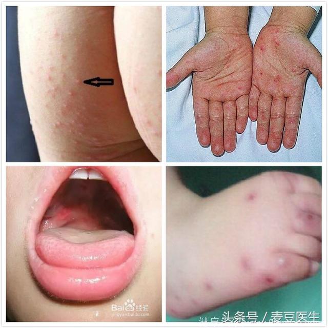首都儿研所专家：孩子这些部位出疹子，一定要小心手足口病！