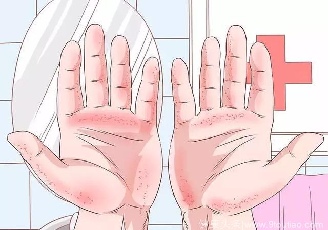 手掌发红是肝硬化征兆？修复肝损伤做好这5件事